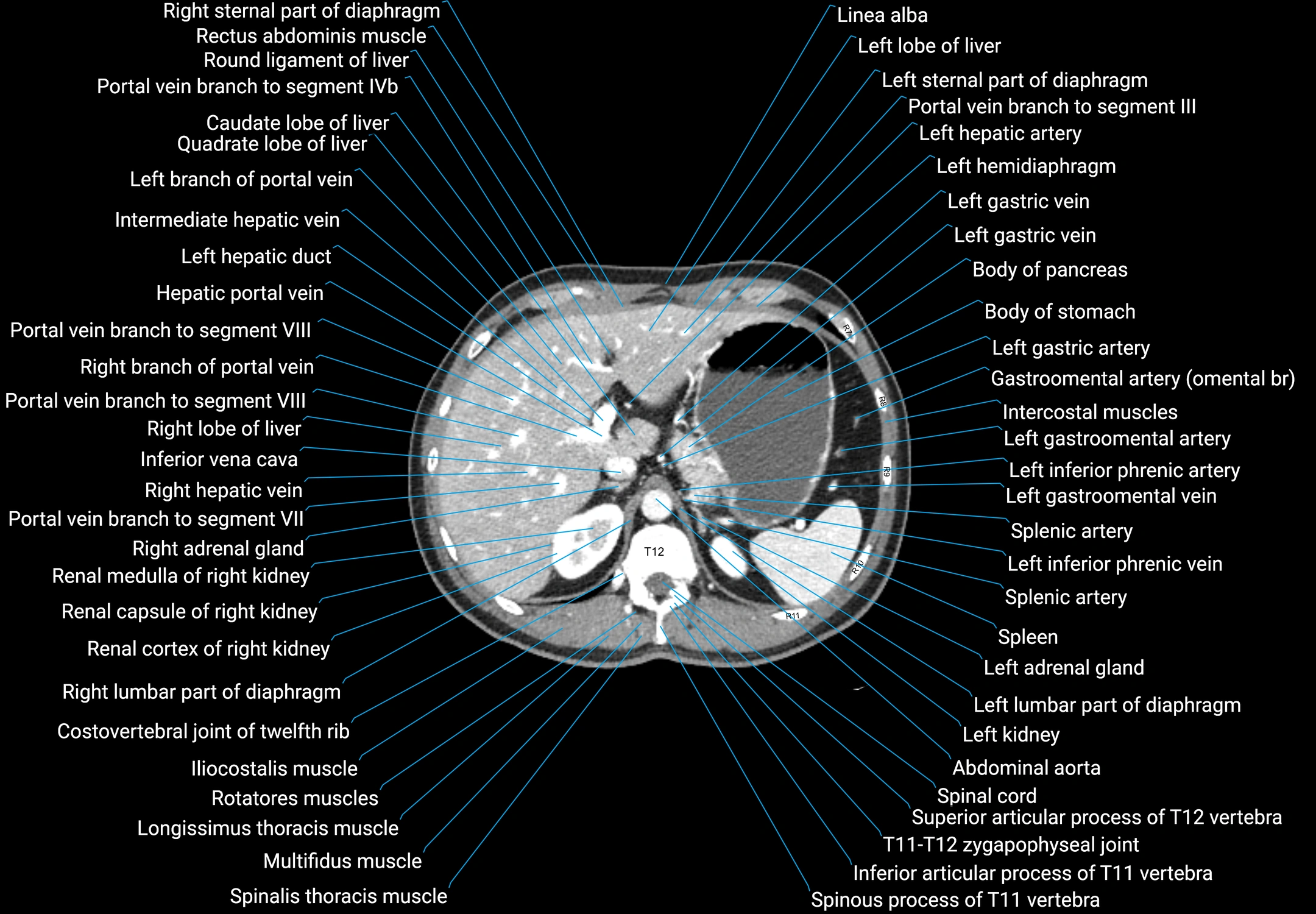 CT male pelvis axial cross sectional anatomy labelled radiology image -00037.webp